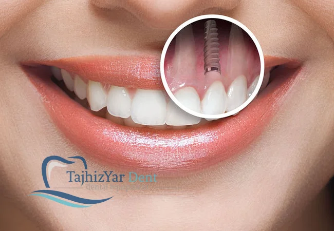 مزایای کاشت دندان بدون جراحی