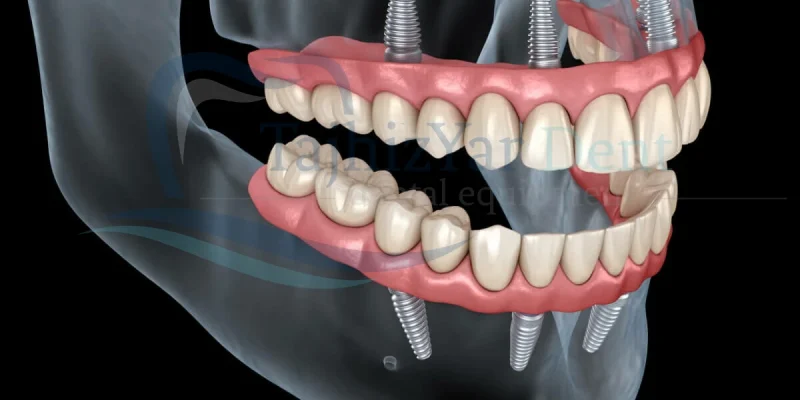مزایای ایمپلنت و دندان مصنوعی
